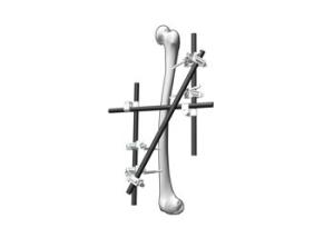 Quality Multipurpose External Fixation System For Serious Backbone Fractures for sale