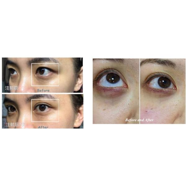 Hyamely Panda Needle Under Eye Dark Circle Hyaluronic Acid Long Lasting Dermal