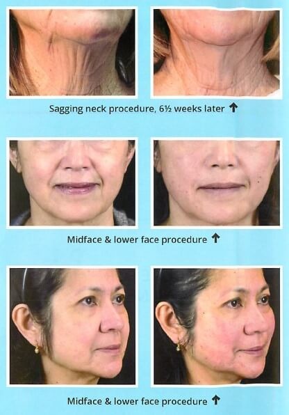 Korea Pdo Medical Suture Face PDO Thread Lift Pcl Sharp 26G 27G Gauge