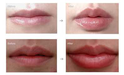 Skin Reborn Hyaluronic Acid Injections Filler For Wrinkles Ampoule Derm 1-2ml