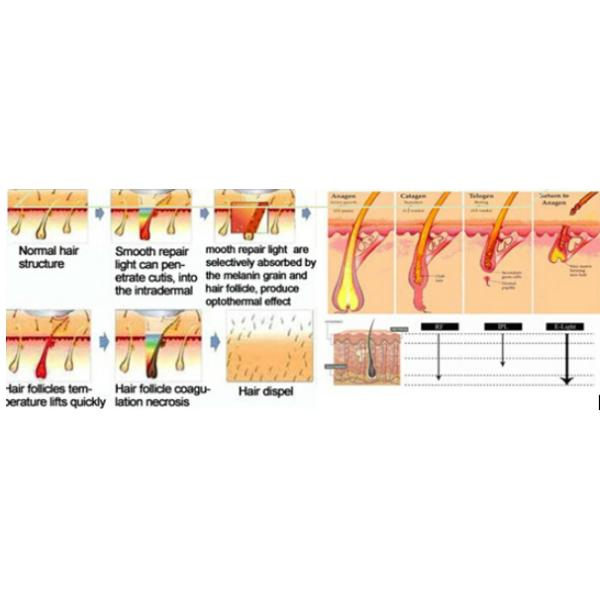 HR SR Handle Portable Ipl Hair Removal Machine SHR Elight 12x30/15x50mm
