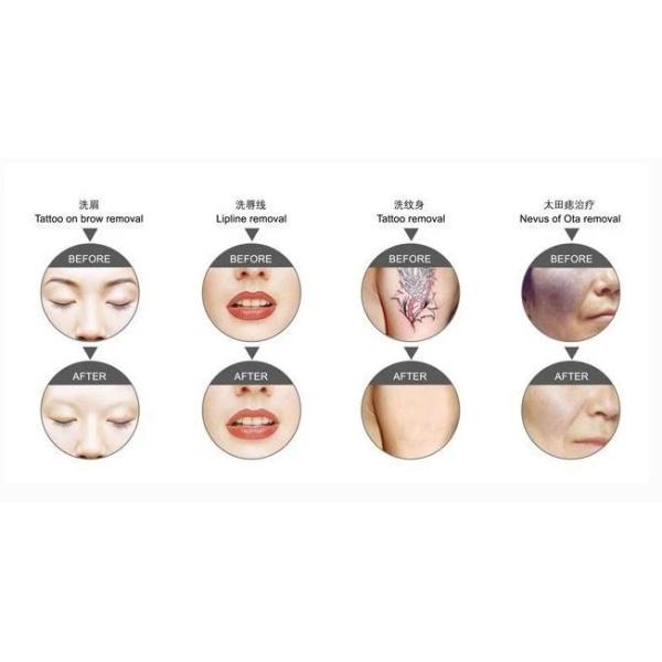 10ns 1064nm 5Hz Q Switch Laser Suitcase Cartridge Tattoo Removal Equipment