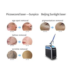 Quality Skin Whitening Picosecond Laser Tattoo Removal Machine Easy Operation for sale