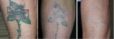 Export Europe Excellent Effective Q Switch Nd Yag Laser Tattoo Removal /Carbon Skin Rejuvenation beauty machine