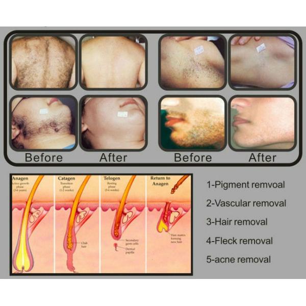 Multifunctional SHR super hair removal skin rejuvenation Machine for clinic use