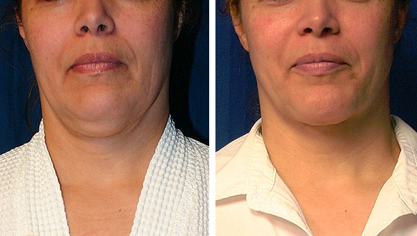 High Intensity Focused Ultrasound HIFU beauty machine for Face Lifting and Wrinkle Removal