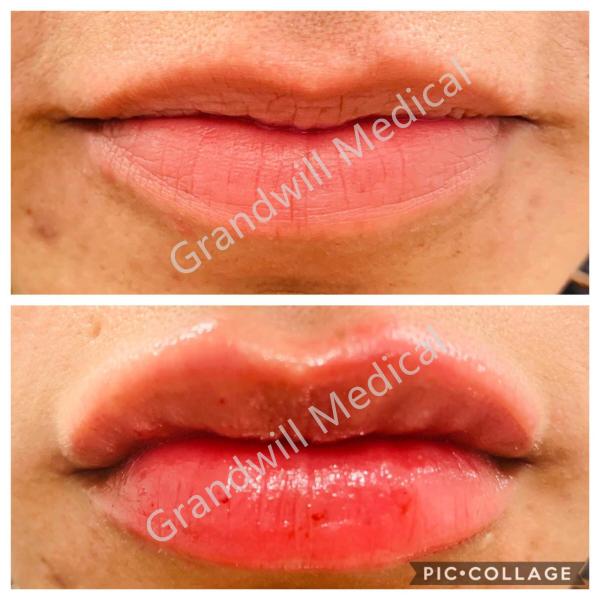 Cross Linked Sodium Hyaluronic Acid Injection Dermal Filler For Lip Fullness Facial Wrinkles