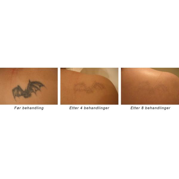 manufacture sales pulse width 6ns q-switched nd yag laser freckles removal machine for tattoo removal