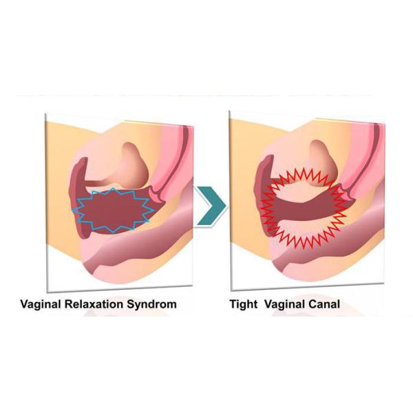 40W 10600nm RF Metal Tube Fractional Co2 Laser Machine with Vaginal Treatment