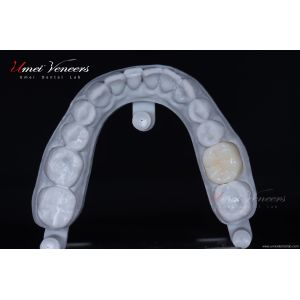Biocompatible zirconia dental veneer