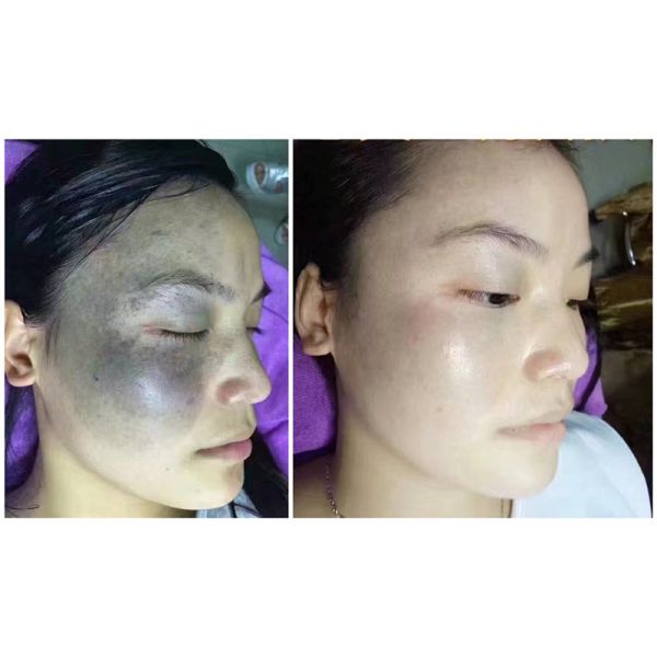 manufacture sales pulse width 6ns q-switched nd yag laser freckles removal machine for tattoo removal