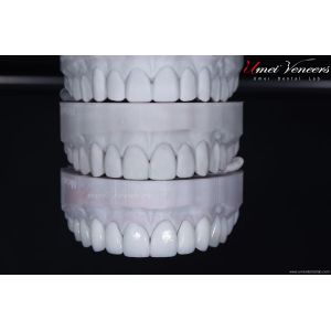 Strong and thin aesthetic veneers
