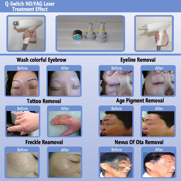Eyebrow Removal Laser Tattoo Removal Machine With Q Switched ND Yag