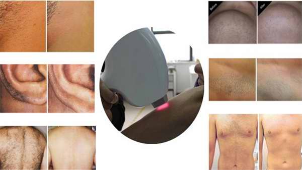 CE FDA approved 808 diode laser permanent hair removal machine system / painless laser hair removal