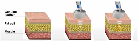 hifu portable beauty machine liposonix hifu for weight loss body shaping
