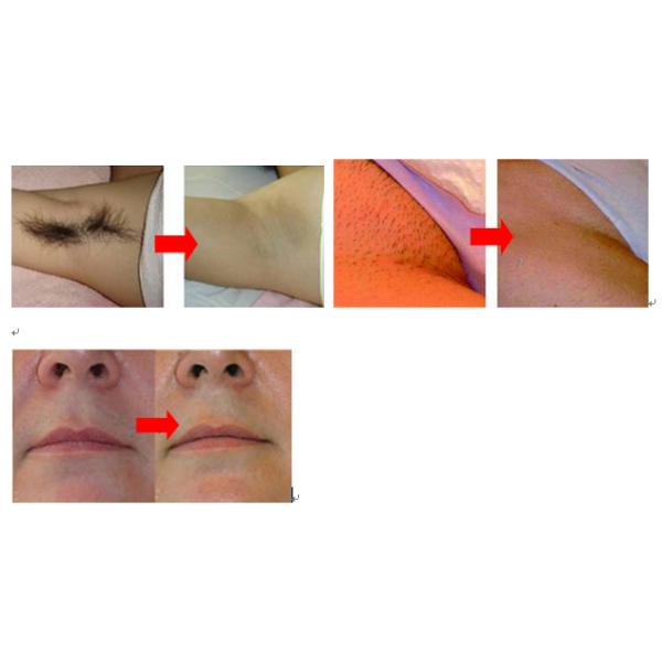 Painless diode laser treatment for hair removal for Face with 10.4" LCD Touch Screen