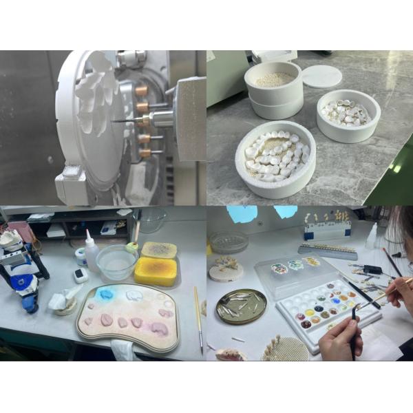 EMAX Porcelain Veneer with Stain Resistance for Natural looking Esthetic Restorations