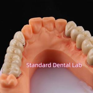 China Digital Non Precious Metal Porcelain Crown PFM Bridge Dental on sale