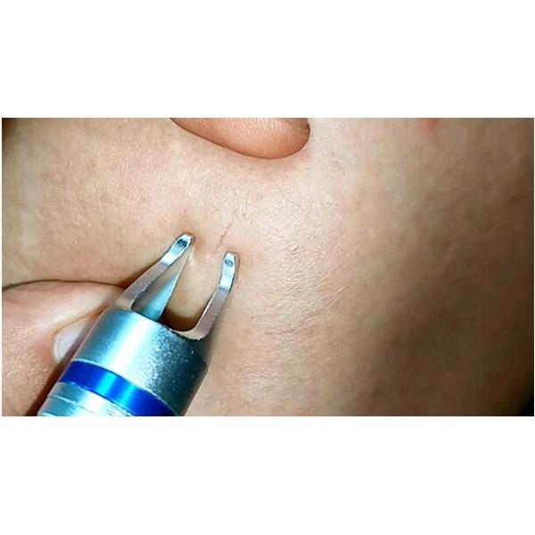 980nm Diode Laser Spider Vein Removal Machine 10W Painfree For Salon