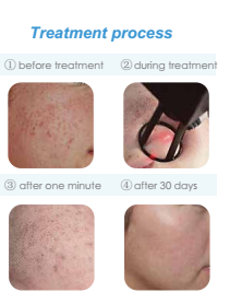 Medical and Salon used co2 laser/laser vaginal tightening machine/co2 fractional laser