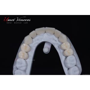 Biocompatible zirconia dental veneer