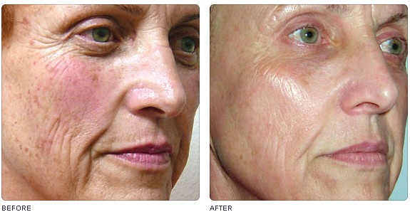 New design 4S multiple 2 display Beauty Machine-IPL&RF&E-light&Nd:YAG laser system