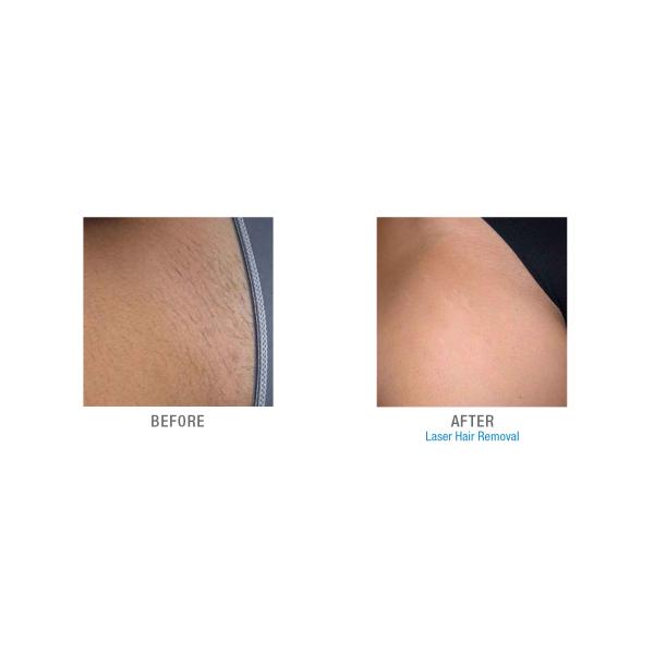 Permanent ND YAG Laser Hair Removal Device For Dark Skin 1064nm Wavelength