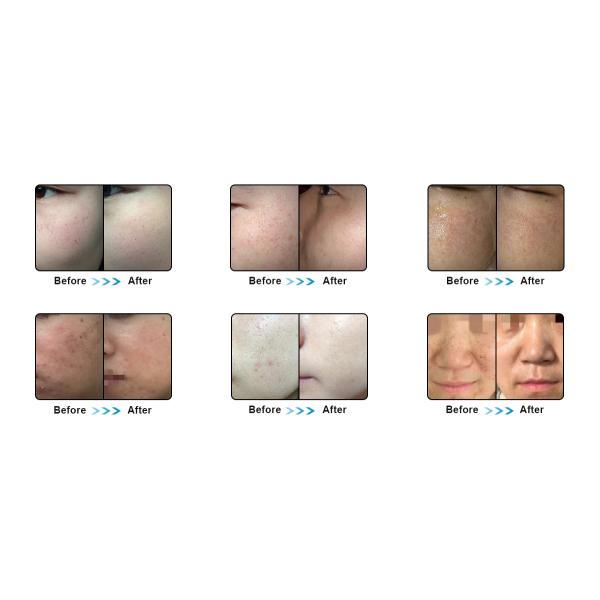 DPL elight IPL HR permanent hair removal acne photorejuvenation facial multifunctional beauty machine