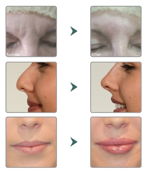 Gel 24mg / Ml Hyaluronic Acid Based Fillers With Syringe