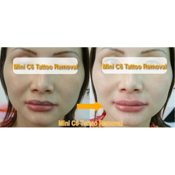 1064nm Yag Laser Tattoo Removal Machine , Q Switch Laser For Face