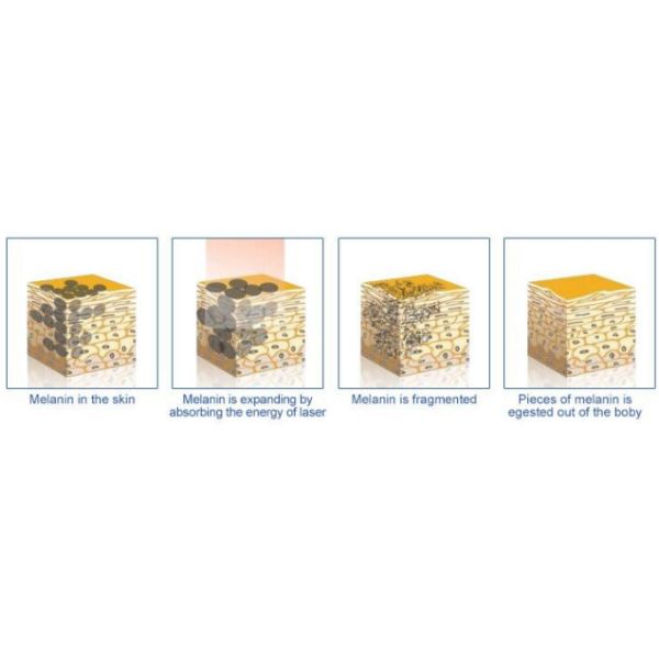 Export Europe Excellent Effective Q Switch Nd Yag Laser Tattoo Removal /Carbon Skin Rejuvenation beauty machine