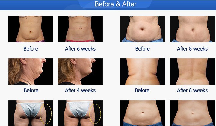 Promotion 80% clinic used 5 handles cryo cavitation rf cryolipolysys cool fat freeze slimming skin tightening machine