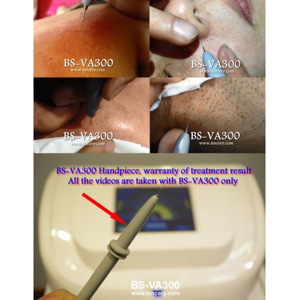 HF Leg Spider Vein / Skin Tag Removal Laser Machine With 0.005mm Tip Diameter