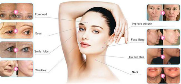 nasolabial removal skin tightening hifu face lift wrinkle removal double chin machine