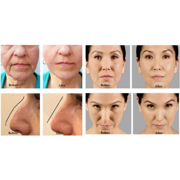 Fosyderm Hyaluronic Acid Face Dermal Filler Cross Linked HA Gel 1ml 2ml 5ml