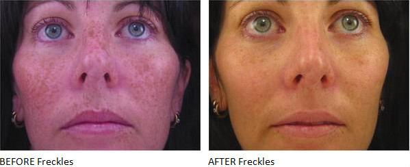 best China three handles mutifunctional hair removal ipl machine price