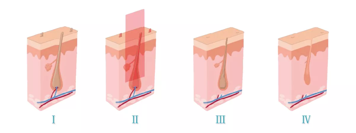 Effective Type 3 In 1 E-Light Opt Shr Ipl Laser Hair Removal Shr Ipl Skin Rejuvenation Machine