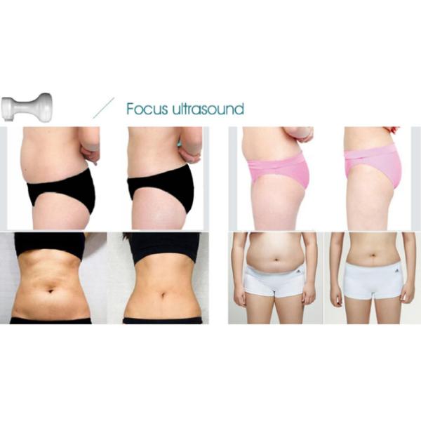 portable hifu for wrinkle removal system and body slimming machine