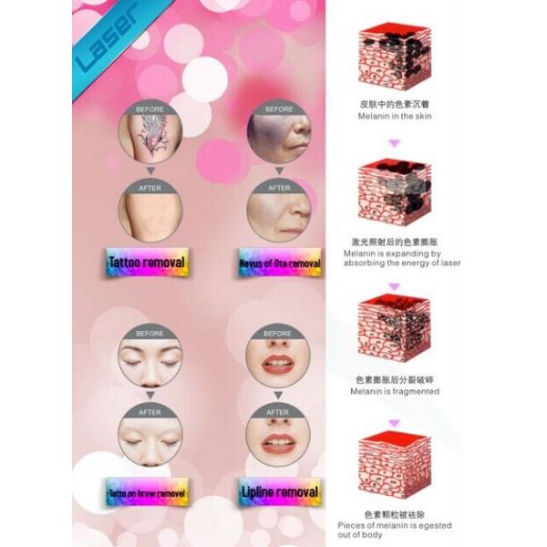 1500mj high energy q-swtiched newest professional laser tattoo removal machine