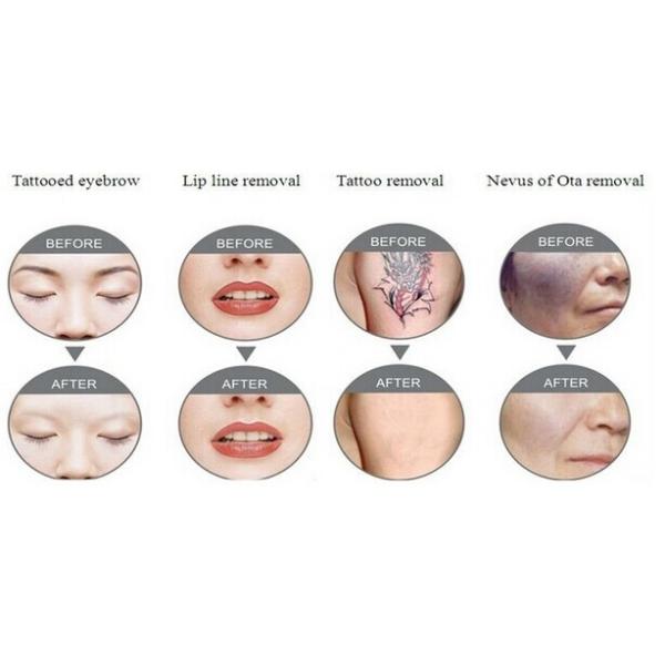 1500mj high energy q-swtiched newest professional laser tattoo removal machine