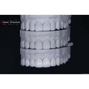 Durable Whitening porcelain veneer