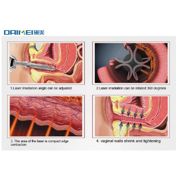 Portable CO2 Fractional Laser Machine For Acne Pigment Removal 10600nm Wavelength