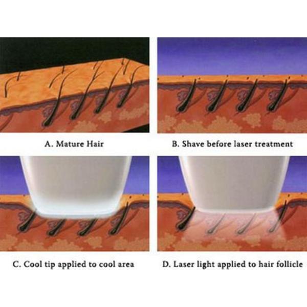 Clinic Use 808nm Diode Laser Hair Removal Machine For Permanent Unwanted Hair Reduction