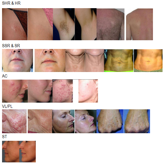 Women Acne Treatment Machine , Fractional Laser Bbeauty Machine for Hair Removel