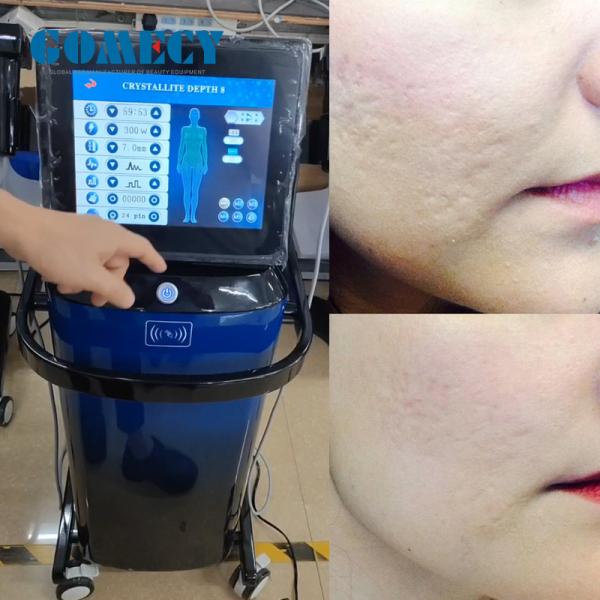 White / Black Microneedle RF Machine 0.5-7mm Needle Length Continuous / Pulse Mode