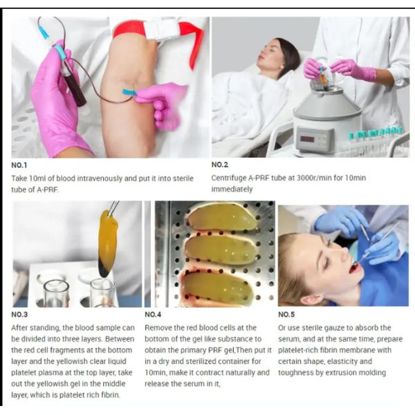 Centrifuge APRF Plastic TUBE 10ml Used For Dental Adhesive Bone