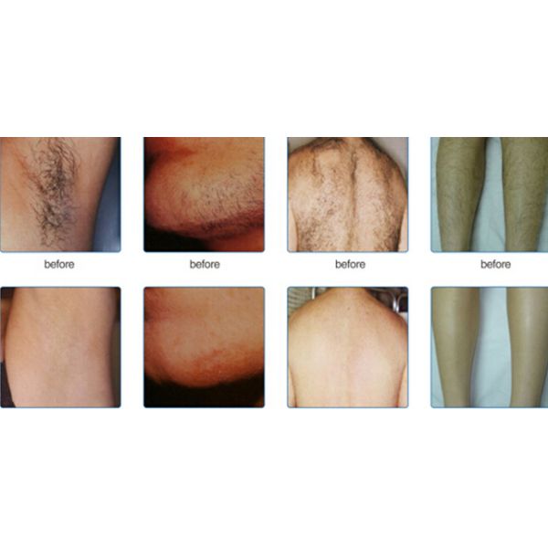 Alma lasers 808nm hair removal laser diode light sheer laser hair removal