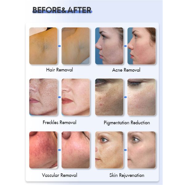 IPL OPT E-light Dpl Skin Rejuvenation Pigment Freckle Laser Hair Removal Machine