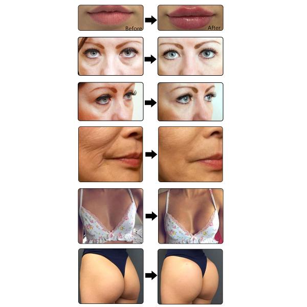 Syringe Wrinkle Removal Hyaluronic Acid Filler 2ml Hyaluronic Acid Injections For Wrinkles