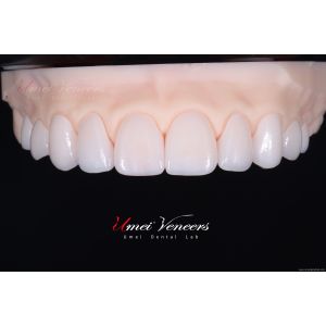 Durable Whitening porcelain veneer
